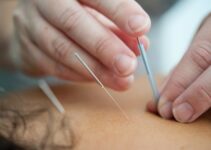 Acupuncture and Arthritis: A Comprehensive Guide