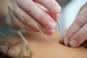 Acupuncture and Arthritis: A Comprehensive Guide