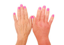 Uncovering the Mystery of Palindromic Rheumatism: A Type of Arthritis