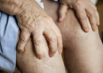 Gout: More Than Just a Type of Arthritis