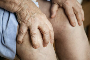 Gout: More Than Just a Type of Arthritis