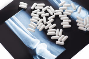 Glucosamine and Chondroitin: Effective Supplements for Arthritis